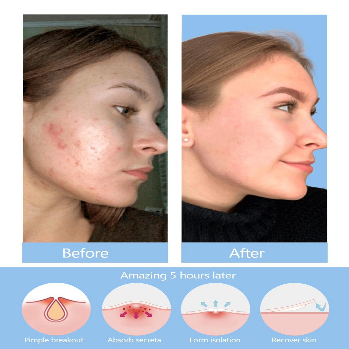 250pcs Hydrocolloid Pimple Patch