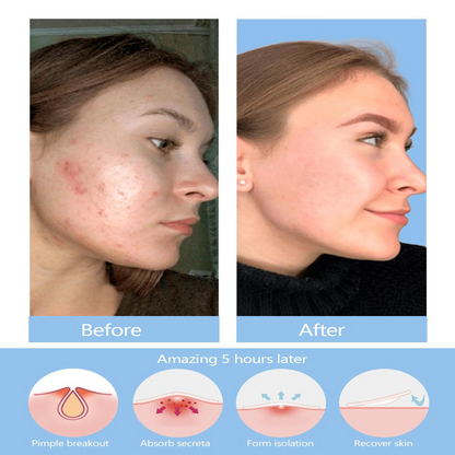 250pcs Hydrocolloid Pimple Patch