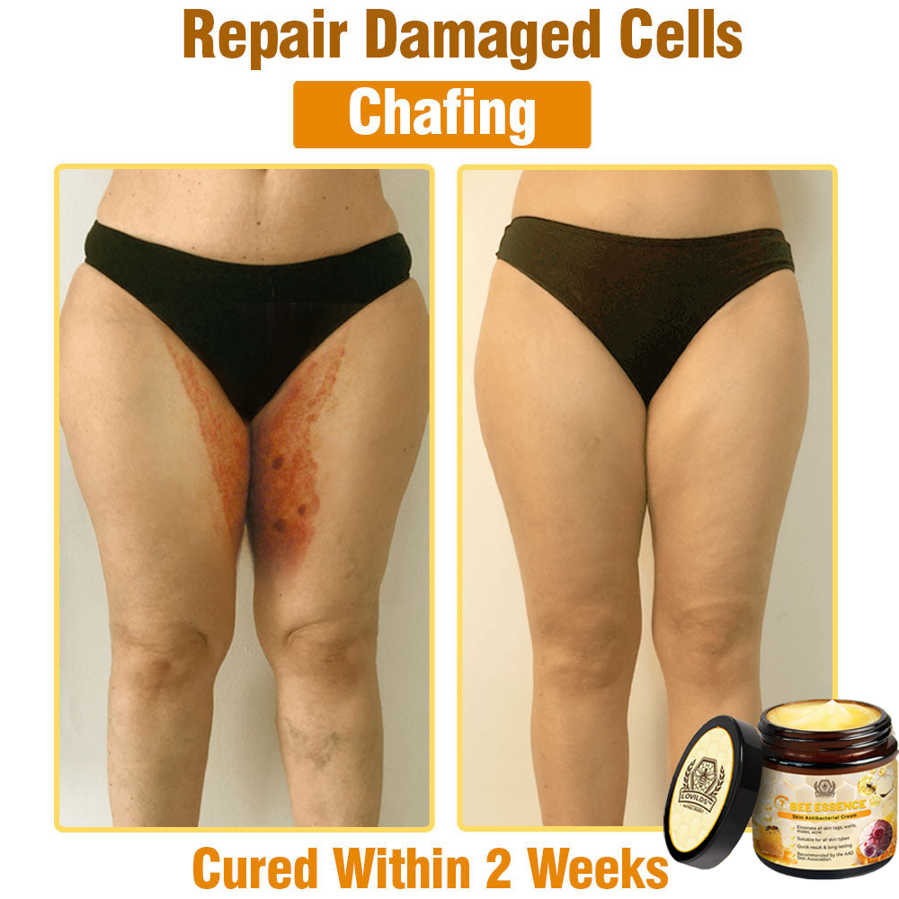 Bee Essence Skin Antibacterial Cream—used to treat a variety of skin diseases (AAD recommended)