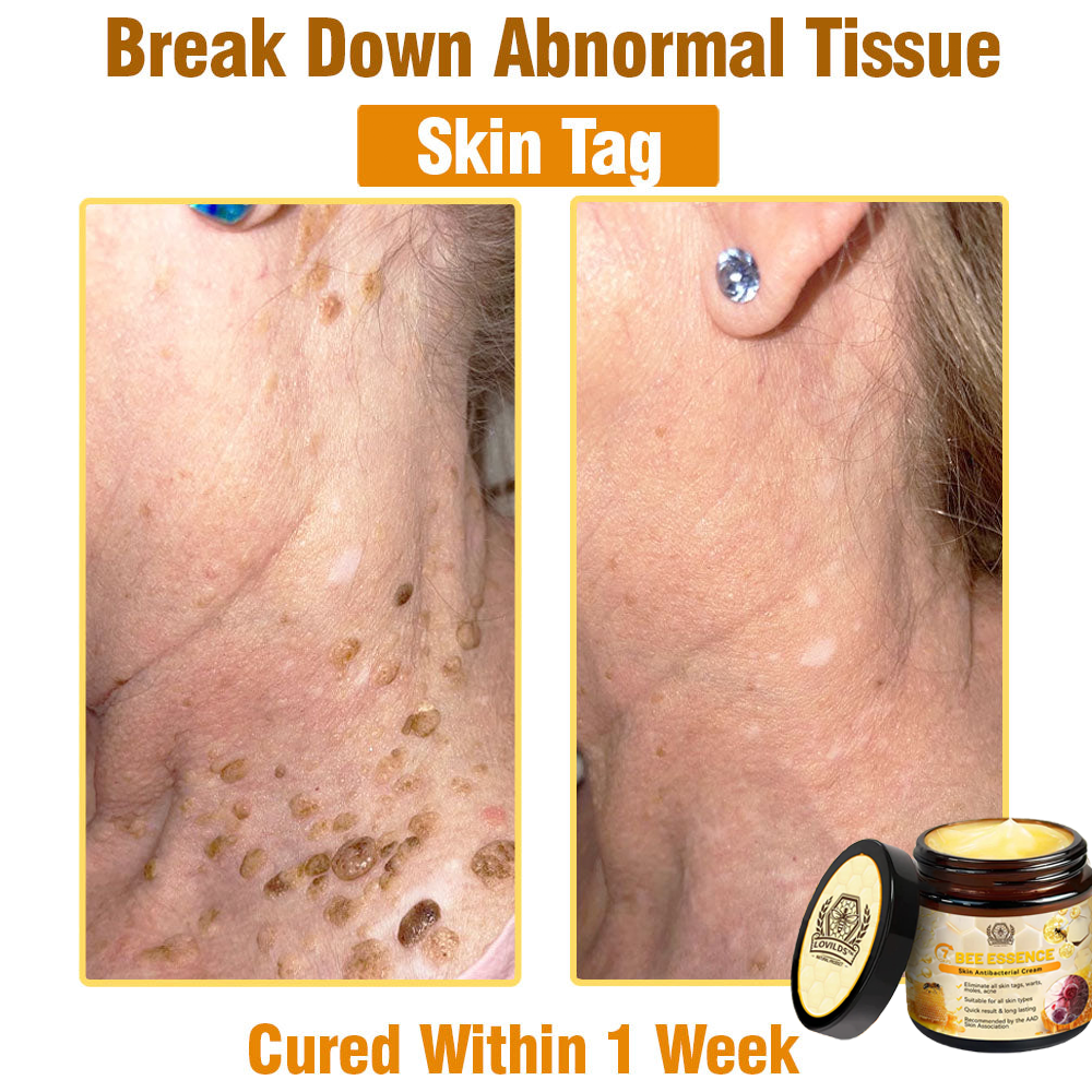 Bee Essence Skin Antibacterial Cream—used to treat a variety of skin diseases (AAD recommended)